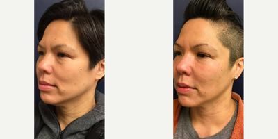 Case 6381 - 45-54 year old woman treated with Botox, Sculptra Aesthetic