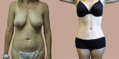 Case 639 - 45-54 year old woman treated with Tummy Tuck