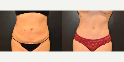 Case 64 - Woman treated with Tummy Tuck