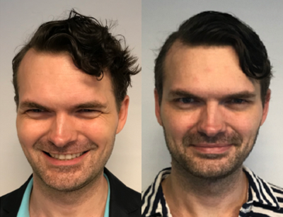 Case 6449 - 35-44 year old man treated with Botox