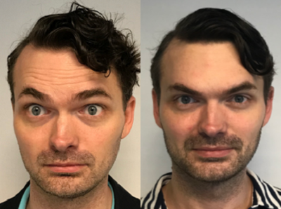 Case 6450 - 35-44 year old man treated with Botox