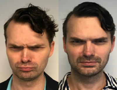 Case 6451 - 35-44 year old man treated with Botox
