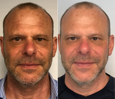 Case 6461 - 45-54 year old man treated with Botox