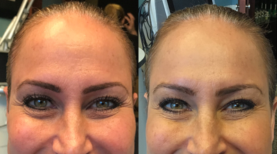 Case 6465 - 35-44 year old woman treated with Botox