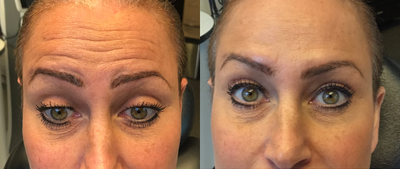 Case 6466 - 35-44 year old woman treated with Botox