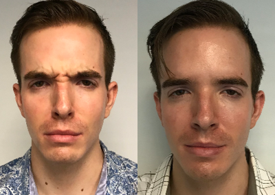 Case 6467 - 25-34 year old man treated with Botox