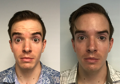 Case 6469 - 25-34 year old man treated with Botox