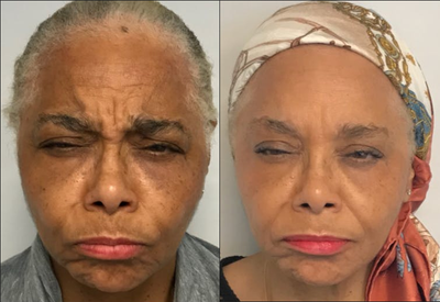 Case 6476 - 65-74 year old woman treated with Botox
