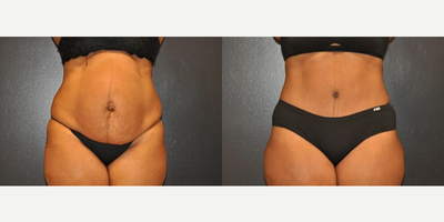 Case 65 - Woman treated with Tummy Tuck