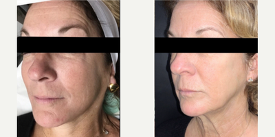 Case 6506 - 55-64 year old woman treated with IPL, Botox