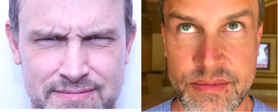 Case 6511 - 25-34 year old man treated with Botox