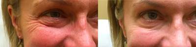 Case 6539 - 45-54 year old woman treated with Botox for Crow's Feet