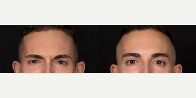 Case 6545 - 25-34 year old man treated with Botox