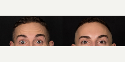 Case 6546 - 25-34 year old man treated with Botox