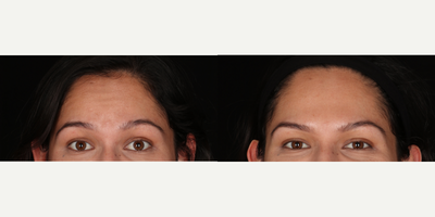 Case 6547 - 25-34 year old woman treated with Botox