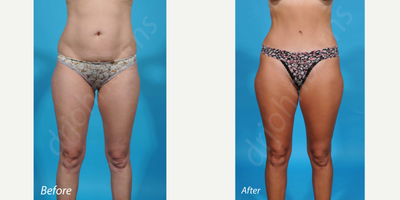 Case 655 - 35-44 year old woman treated with Tummy Tuck
