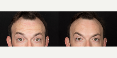 Case 6557 - 32 year old man treated with Botox