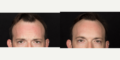 Case 6558 - 32 year old man treated with Botox