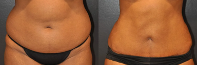 Case 66 - Woman treated with Tummy Tuck