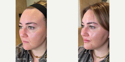Case 6631 - 35-44 year old woman treated with Botox