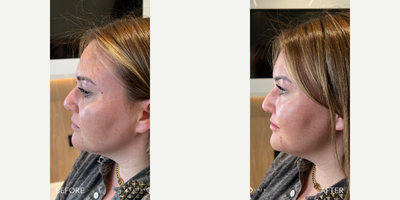 Case 6632 - 35-44 year old woman treated with Botox