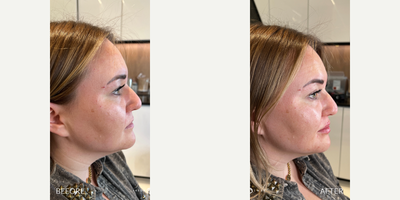 Case 6633 - 35-44 year old woman treated with Botox