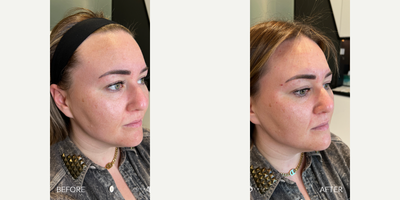 Case 6634 - 35-44 year old woman treated with Botox