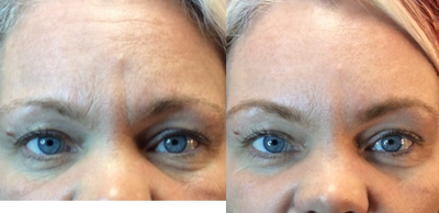 Case 6663 - 35-44 year old woman treated with Botox