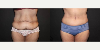 Case 668 - Woman treated with Tummy Tuck