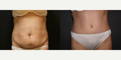 Case 669 - Woman treated with Tummy Tuck