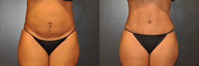 Case 67 - Woman treated with Tummy Tuck