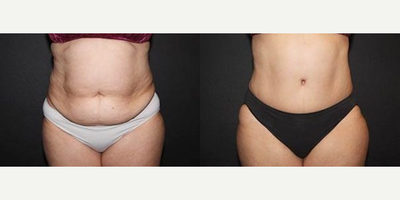 Case 670 - Woman treated with Tummy Tuck