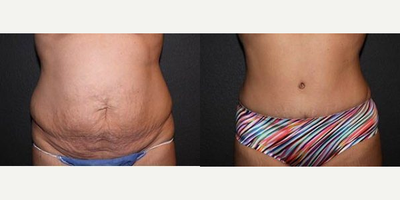 Case 671 - Woman treated with Tummy Tuck