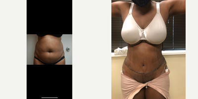 Case 672 - 45-54 year old woman treated with Tummy Tuck