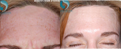 Case 6765 - 45-54 year old woman treated with Botox