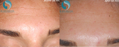 Case 6766 - 35-44 year old woman treated with Botox
