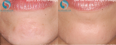 Case 6767 - 35-44 year old woman treated with Botox