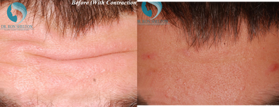 Case 6768 - 25-34 year old man treated with Botox