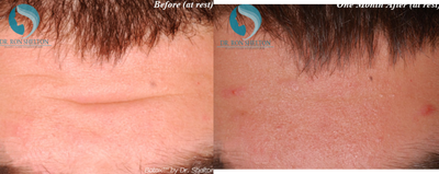 Case 6769 - 25-34 year old man treated with Botox
