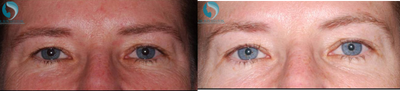Case 6770 - 45-54 year old woman treated with Botox