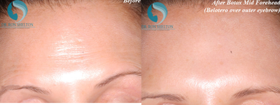 Case 6771 - 35-44 year old woman treated with Botox