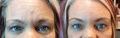 Case 6783 - 45-54 year old woman treated with Botox