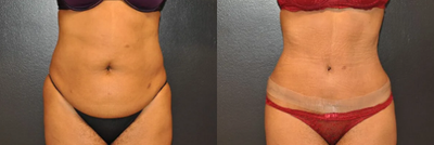 Case 68 - Woman treated with Tummy Tuck