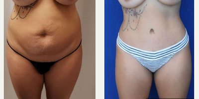 Case 680 - Woman treated with Tummy Tuck