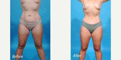 Case 681 - 35-44 year old woman treated with Tummy Tuck