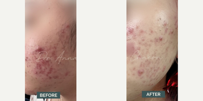 Case: 6826 - before and after photo of Woman treated with Accutane by Anna Chacon, MD, FAAD