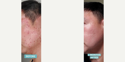 Case: 6827 - before and after photo of Man treated with Accutane by Anna Chacon, MD, FAAD