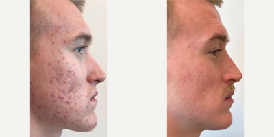 Case: 6828 - before and after photo of 21 year old man treated with Accutane by Timothy Jochen, MD