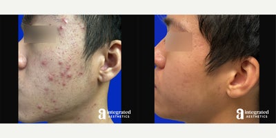 Case: 6829 - before and after photo of 18-24 year old man treated with Accutane by Melissa Chiang, MD, FAAD