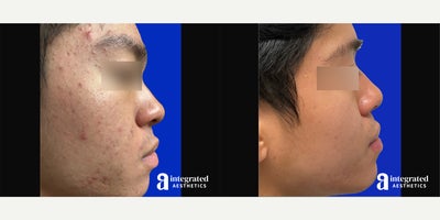 Case: 6830 - before and after photo of 18-24 year old man treated with Accutane by Melissa Chiang, MD, FAAD